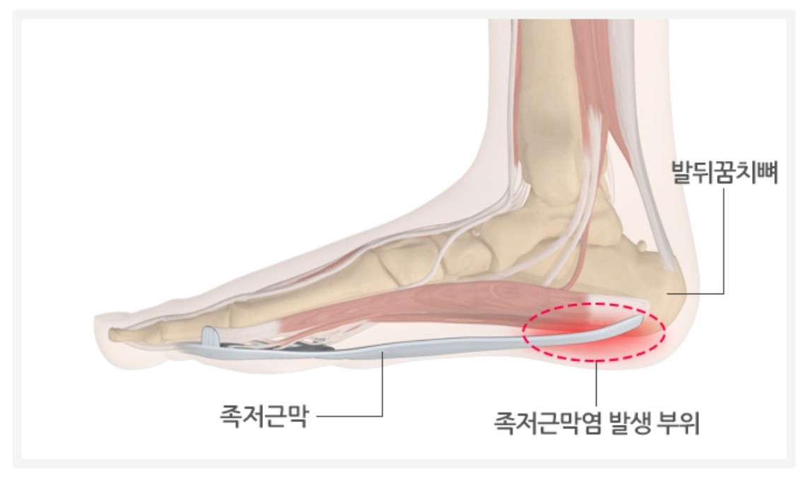  족저근막염 증상 마사지