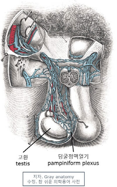 의학용어 varicocele 뜻 덩굴정맥류, 정계정맥류와 남성불임의 원인