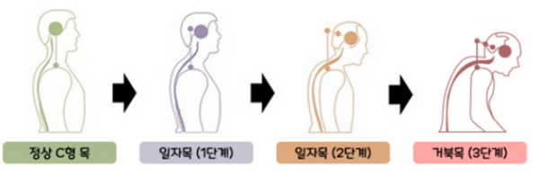 거북목 3단계