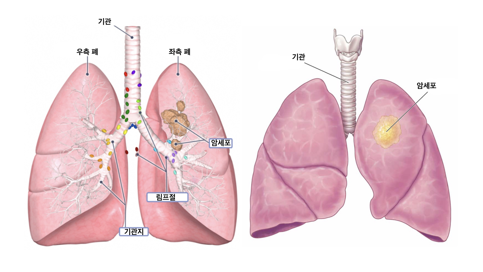 폐의 구조&#44; 폐암