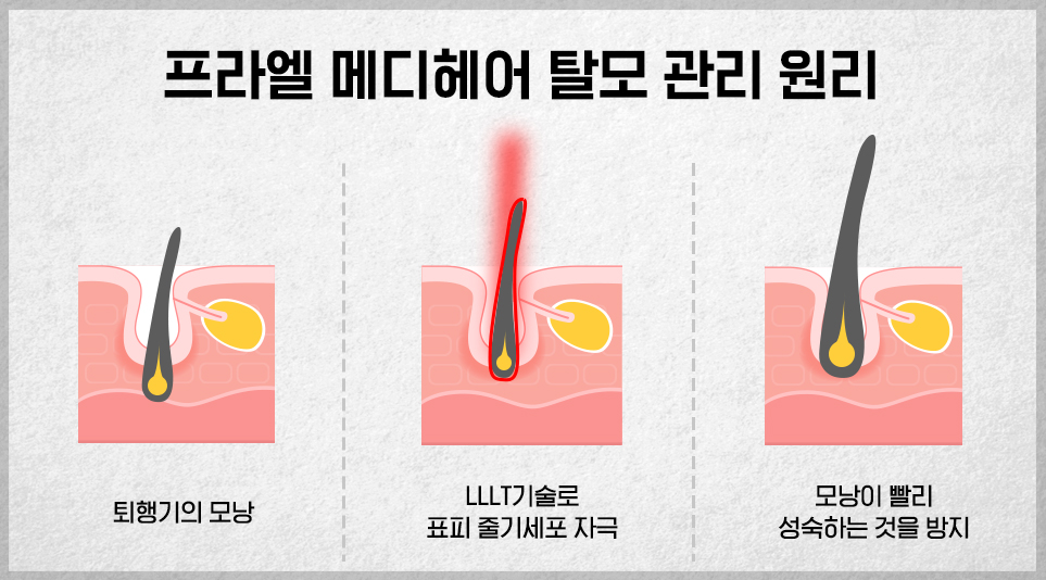 탈모에 도움을 주는 LLLT 기술