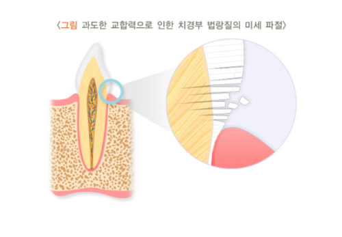 굴곡파절-썸네일