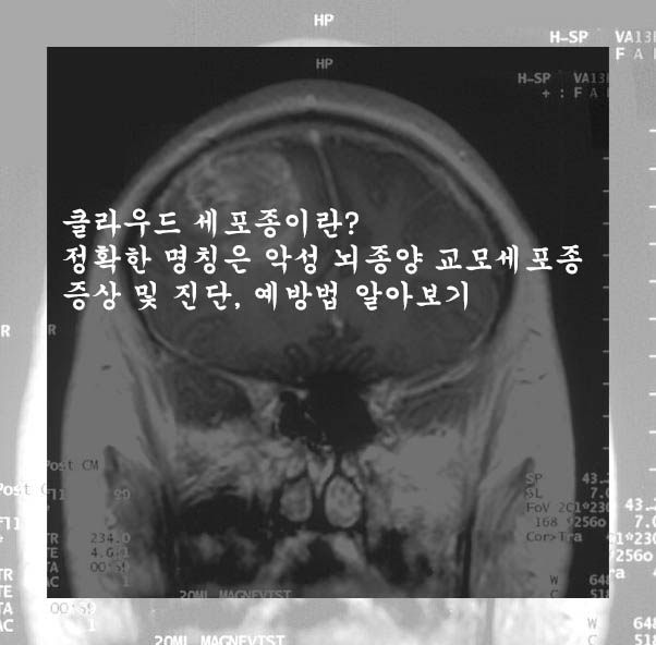  클라우드 세포종이란? 정확한 명칭은 악성 뇌종양 교모세포종 증상 및 진단, 예방법 알아보기