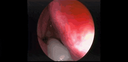  (혐) 콧물 덩어리 석션.gif