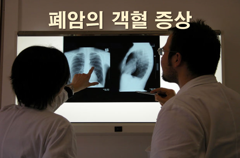 폐암의 객혈 증상과 피 섞인 가래 증상