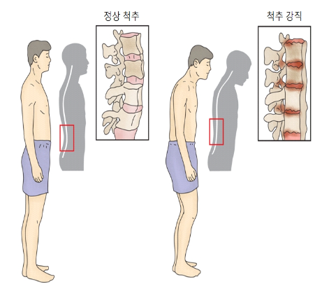  강직성 척추염 원인/증상/치료