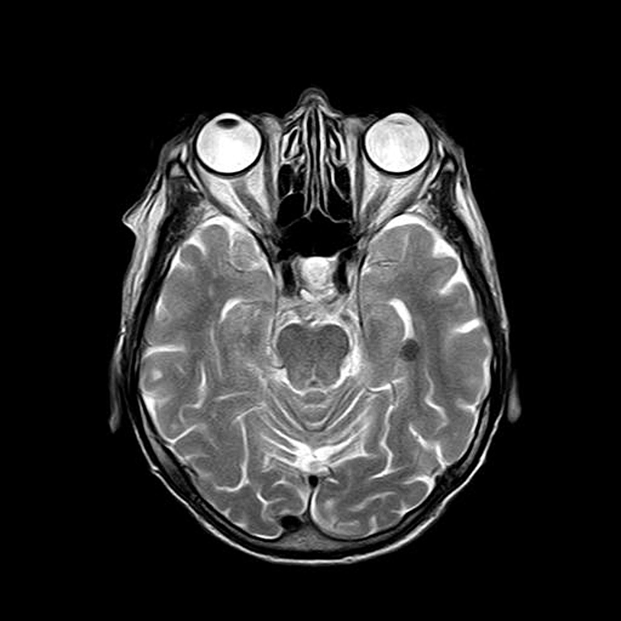 MRI 출혈