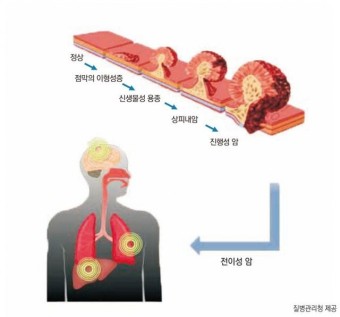 대장암초기증상
대장암 치료