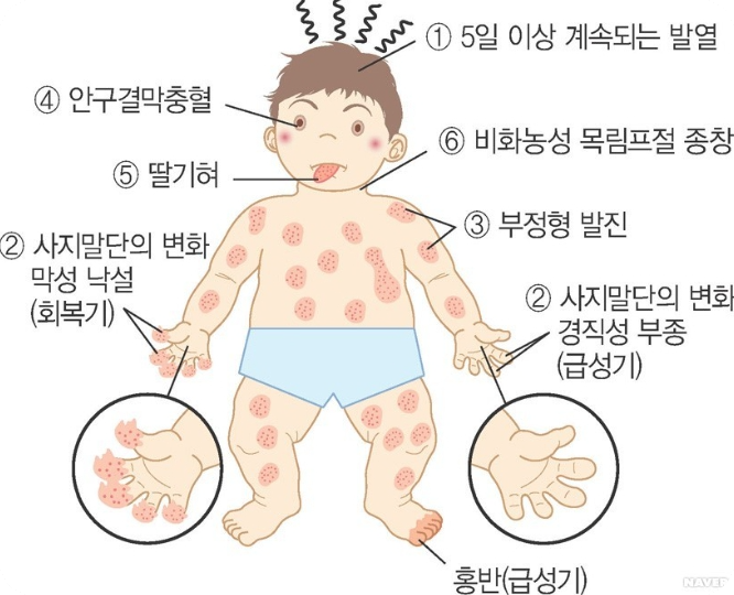 가와사키병의 증상 및 진단기준