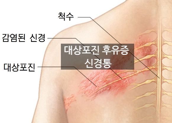 대상포진 후유증