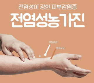 유아 농가진: 원인&#44; 증상&#44; 치료법