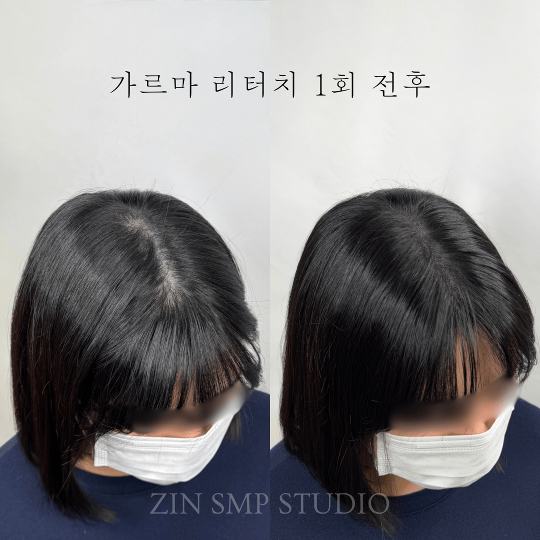홍대두피문신