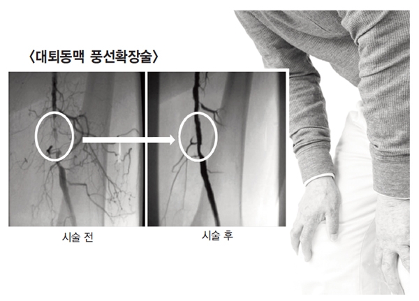 풍선확장술