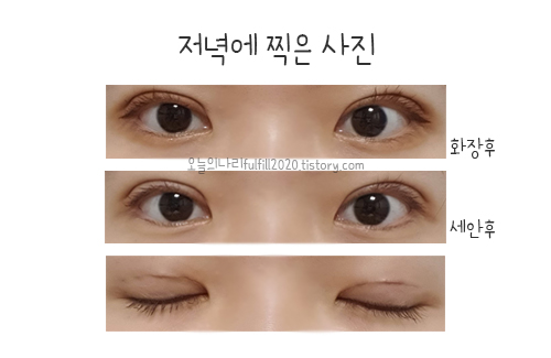 쌍수후기]부분절개+눈매교정 재수술(8~14일차 2주 붓기사진)