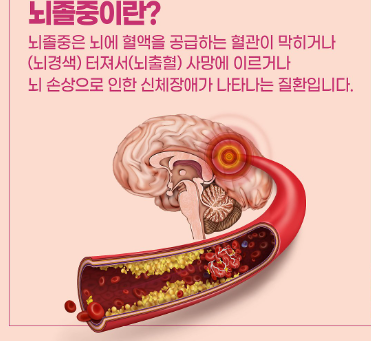 뇌졸중 발생시 대처방법