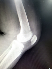 슬개골 연골 연화증