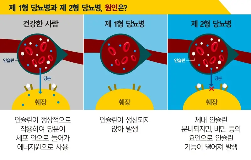 1형 당뇨병 vs 2형 당뇨병