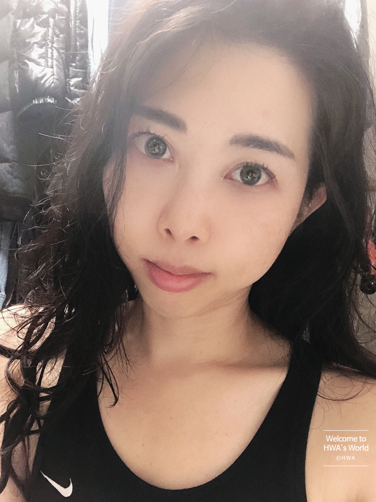 콧볼 축소 비용 [강남/보톡스] 콧볼축소주사-후기 8