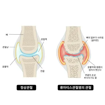 관절염에 좋은 음식 TOP 10_25