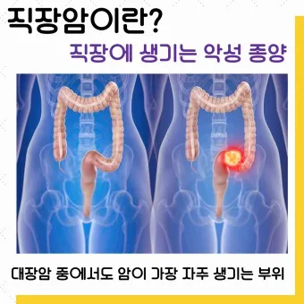 직장암 3기 전이 항암치료 로봇수술_26