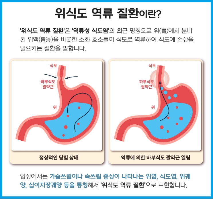 위식도 역류질환 완치법과 좋은 음식, 생활습관 가이드