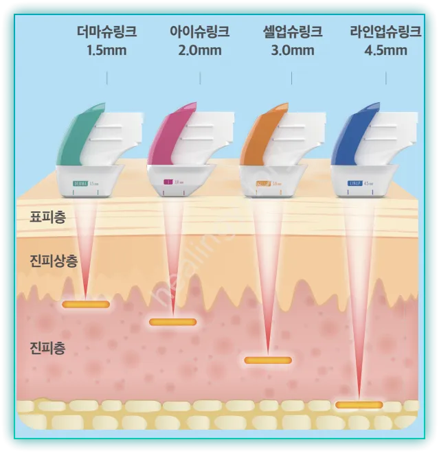 슈링크시술범위