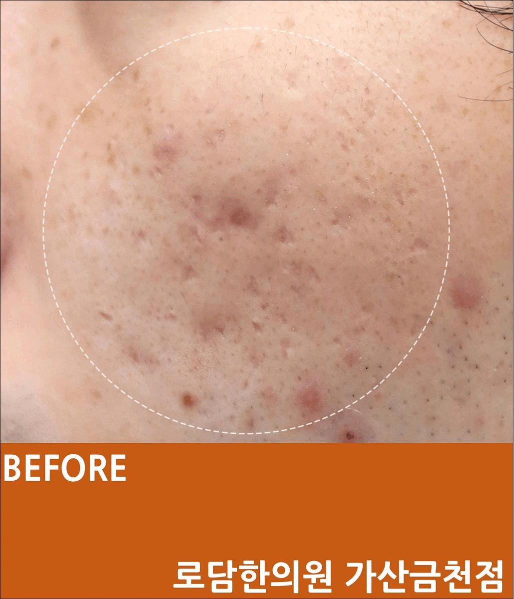  부천 여드름 흉터 곰보 자국 치료 과정 새살침