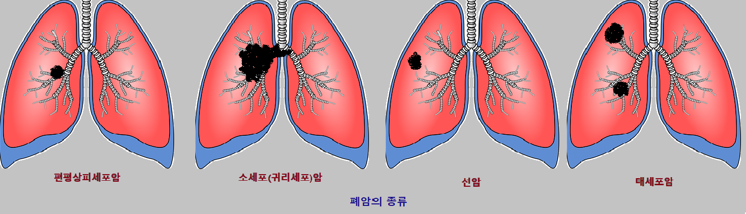  폐암. 폐암 진단. 폐암 종류 알아보기. 폐암 검사방법. 폐암 담배를 피나요?