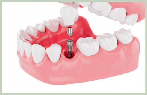 임플란트 종류