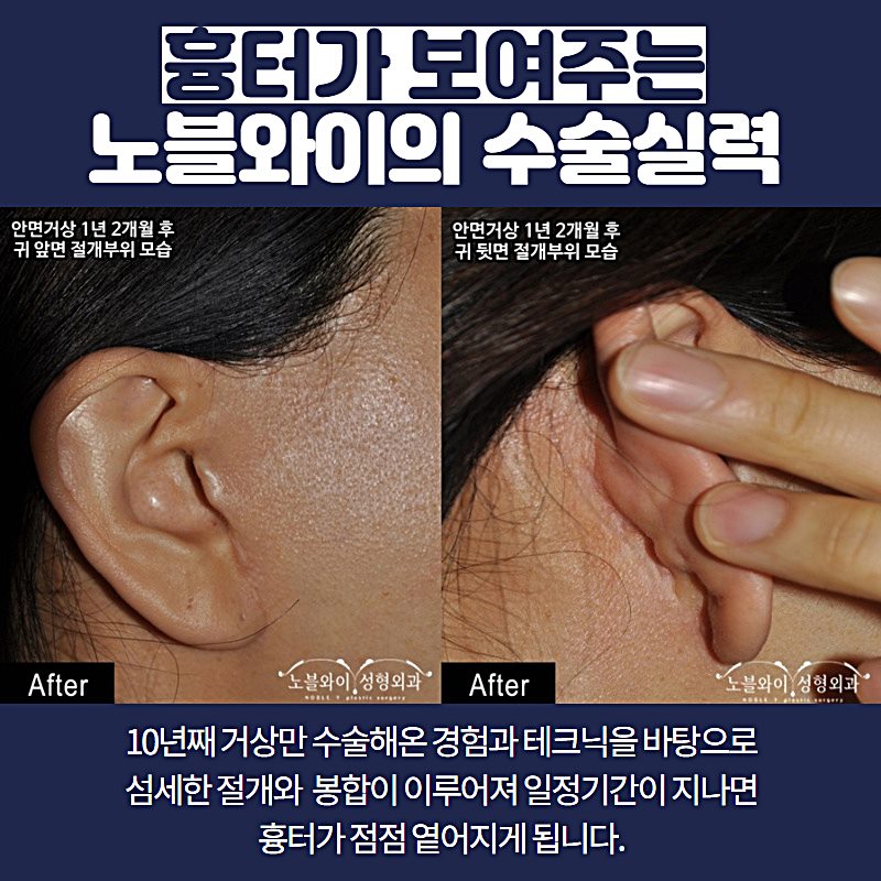  안면거상술흉터 귀앞과 귀뒤 사진