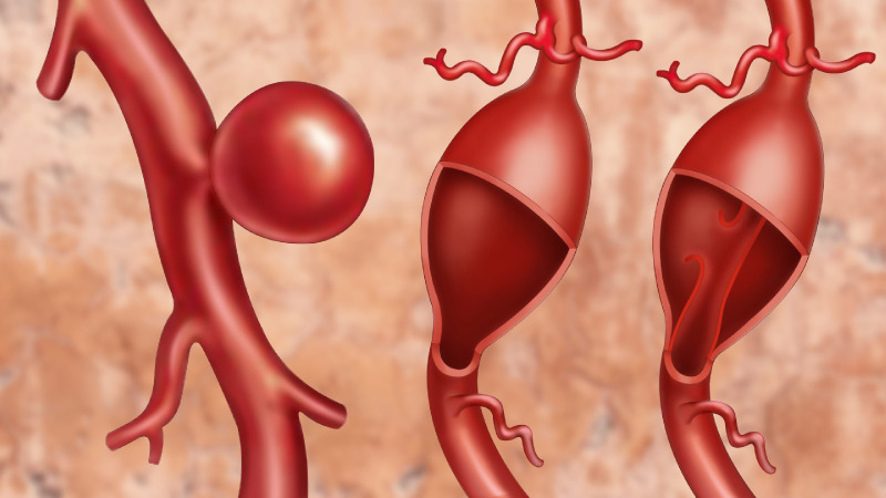  대동맥류(Aortic aneurysm) : 대동맥류란? 대동맥류 원인, 흡연 대동맥류, 대동맥류 증상