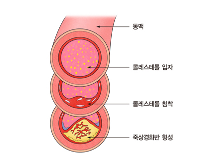 동맥경화증