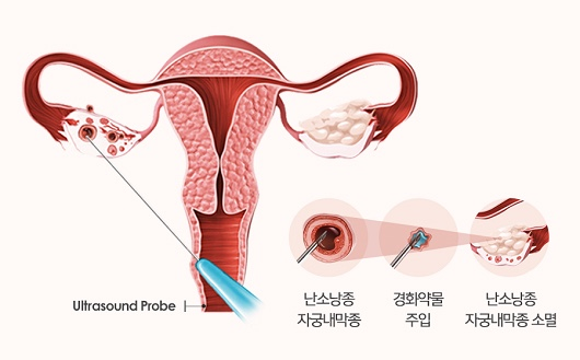 난소낭종의 치료