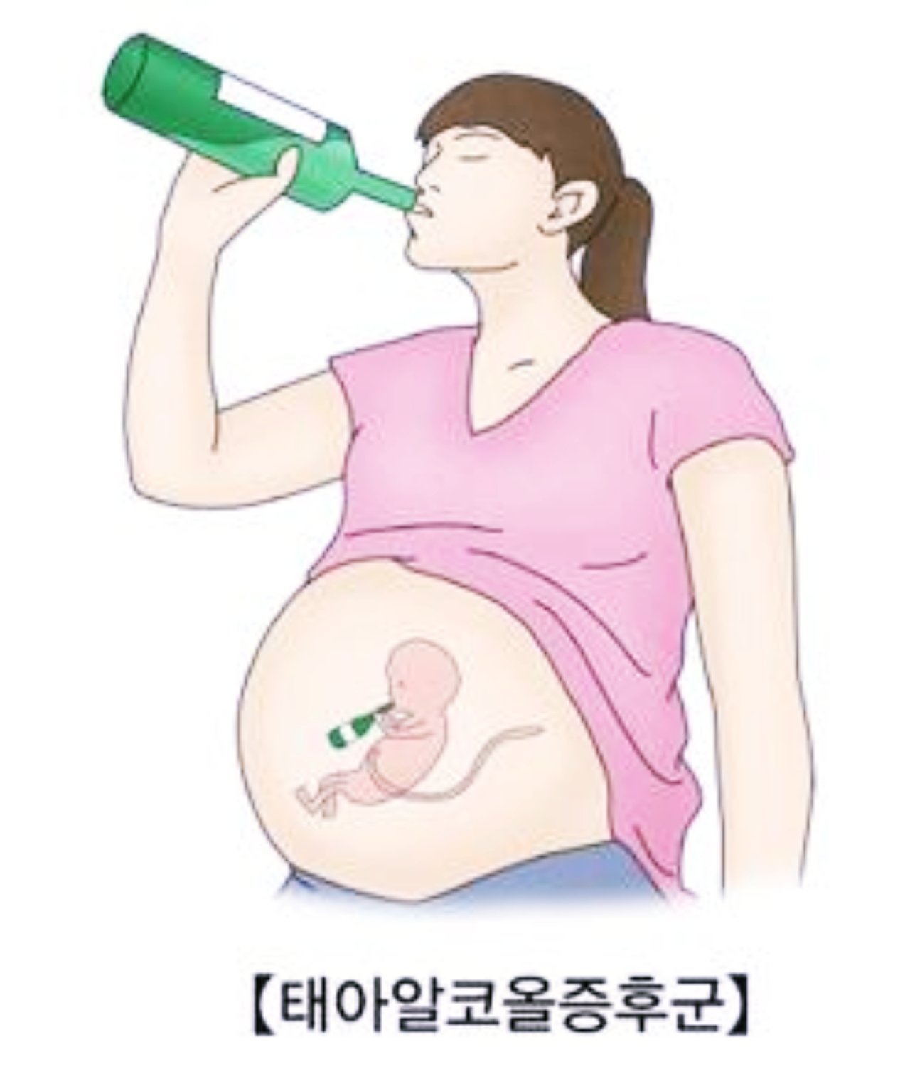  임신 극초기 술 영향 태아 프로그래밍 태아 알콜 증후군