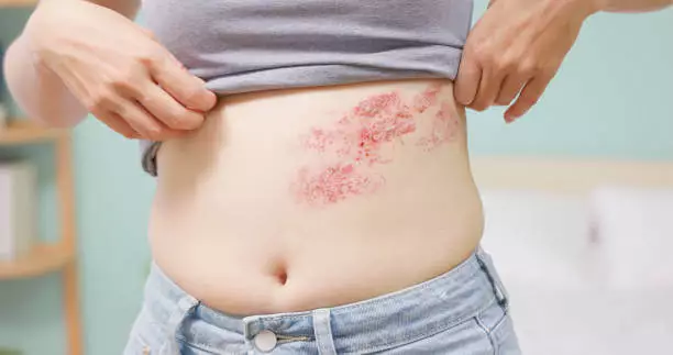 대상포진 초기증상 치료방법