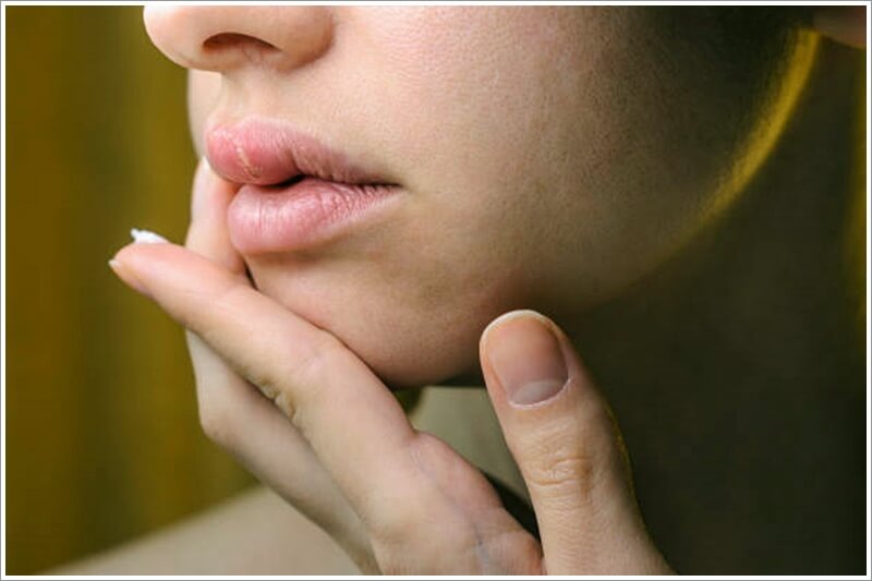 환절기에 주로 발생하는 입술옆 찢어짐-또는 구각염