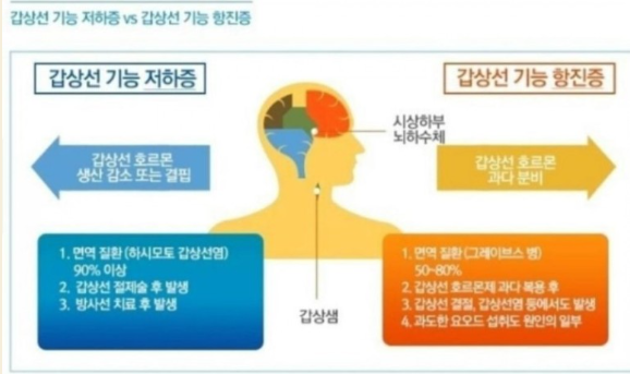 갑상선 초기증상