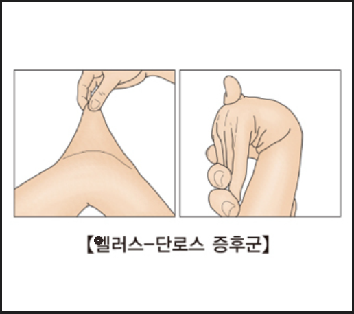 엘러스-단로스 증후군