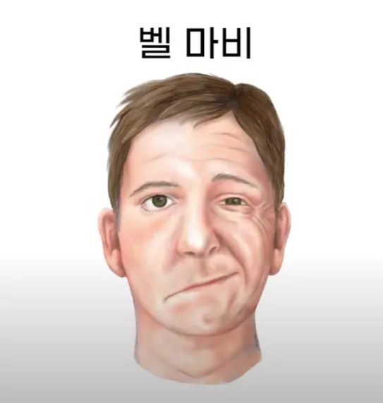 안면마비 발생 시 얼굴 표정 사진