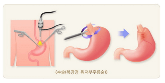 역류성 식도염 자연치료 방법 식도염 자가치료