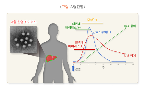  A형간염