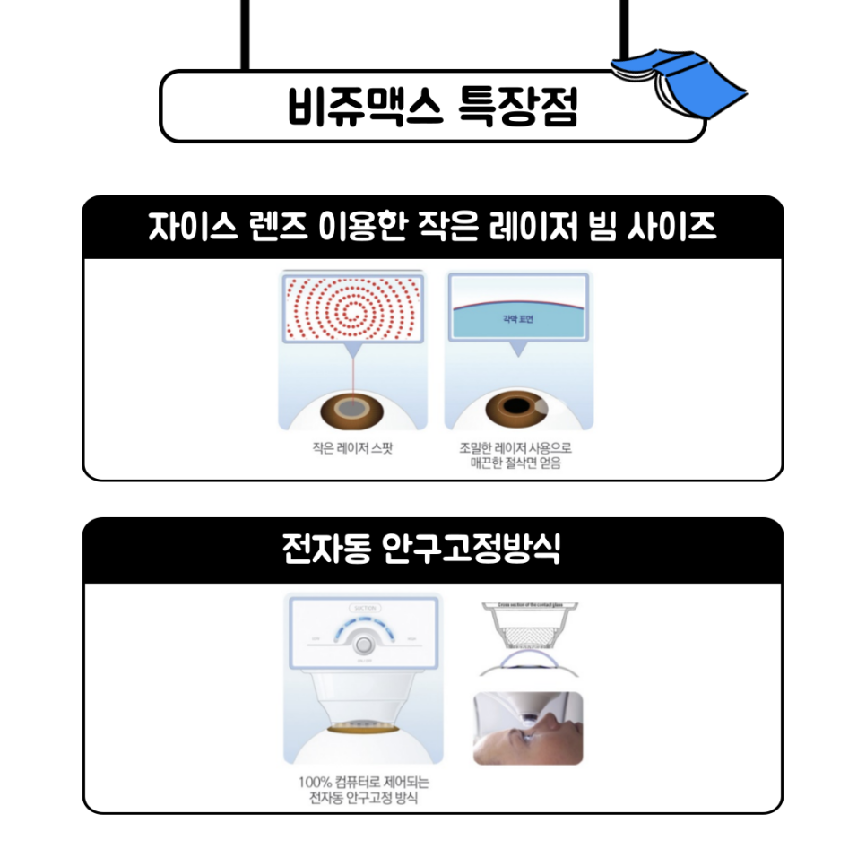  스마일라식  비쥬맥스 A to Z