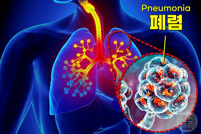 폐렴구균 예방접종 시기 부작용 비용 무료