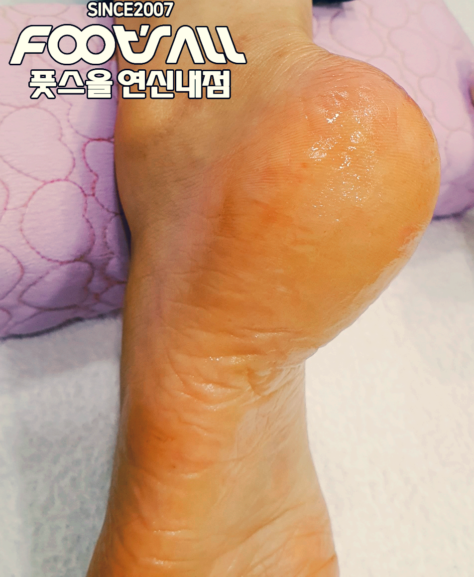 이 이미지는 40대 후반 여성의 발 뒤꿈치 상태를 보여줍니다. 피부가 윤기 있어 보이고, 건조함이나 각질이 거의 없는 모습입니다. 배경에는 보라색 패턴의 쿠션이 있으며, 오른쪽 상단에는 "Since 2007 FOOTSALL(풋스를 연신내점)"이라는 브랜드 텍스트가 표시되어 있습니다.