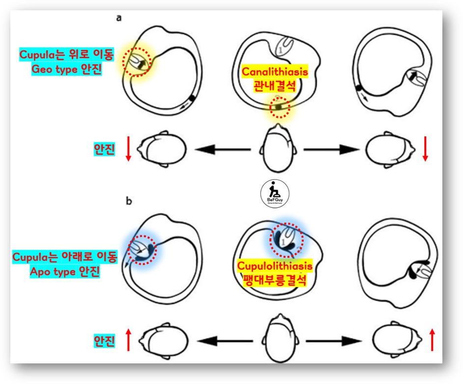 관내결석 Canalithiais? / 팽대부릉결석 Cupulolithiasis?