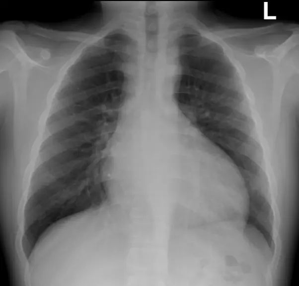 좌심실비대, 대동맥판역류 환자의 xray