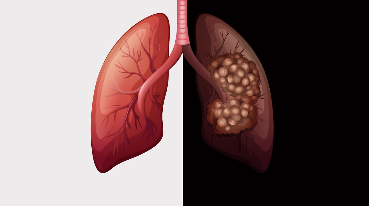 폐암 사진