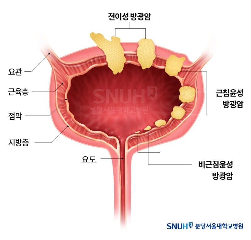 방광암 초기증상 원인 자가진단 정보 총정리2