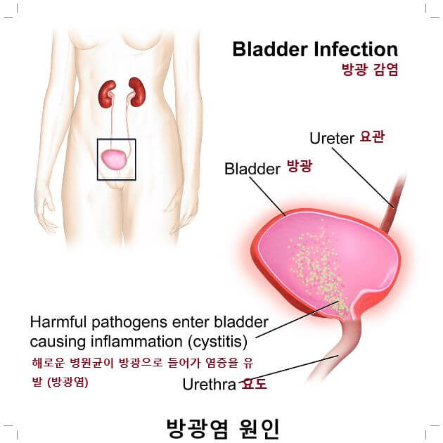 방광염 증상