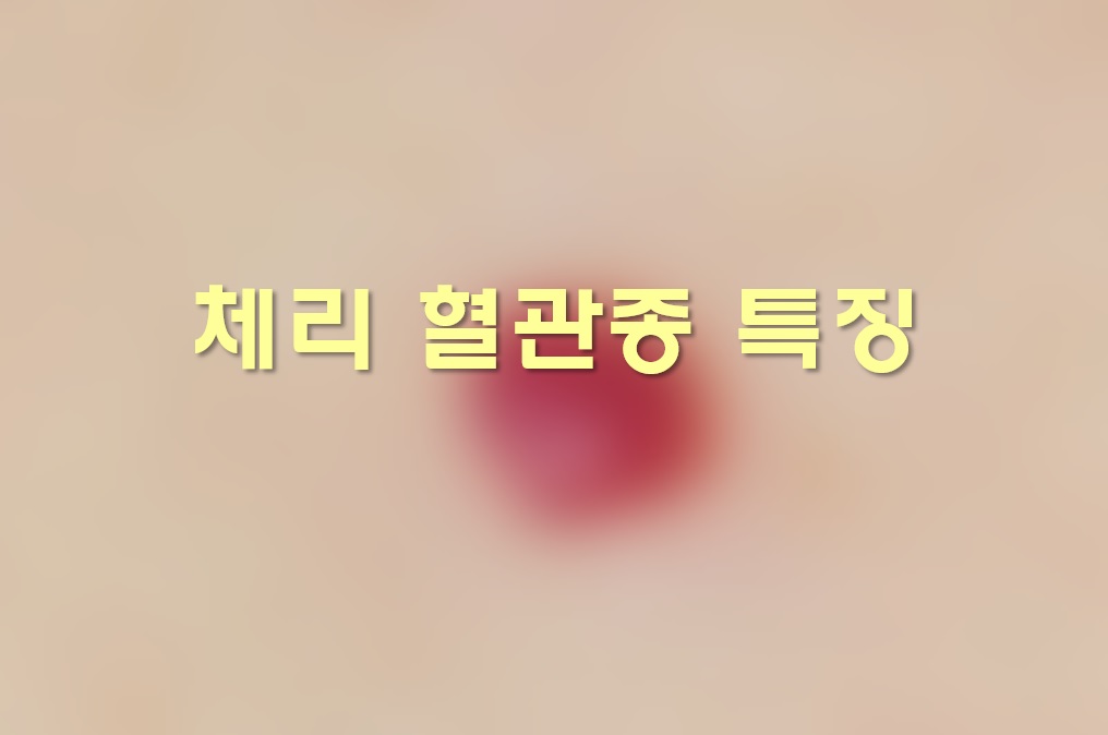  체리 혈관종 치료와 예방